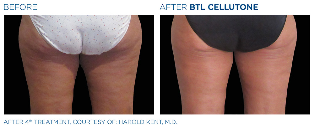 Before and after | CELLUTONE | Cellulite Treatments