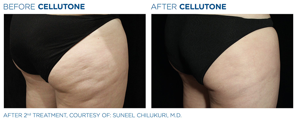 Before and after | CELLUTONE | Cellulite Treatments