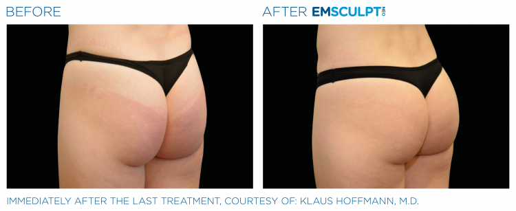 Before and after | EMSCULPT NEO | Body Sculpting