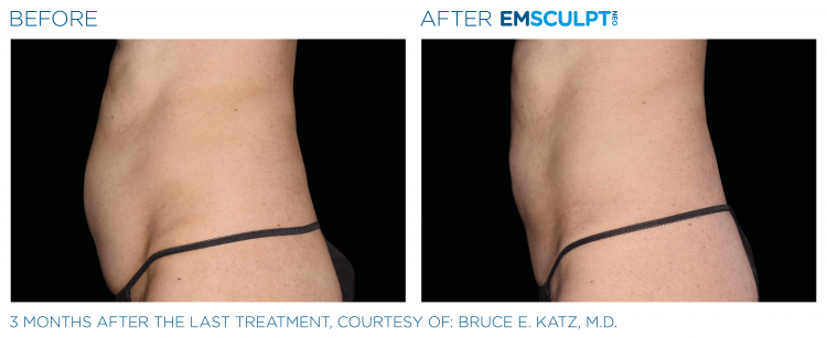 Before and after | EMSCULPT NEO | Body Sculpting