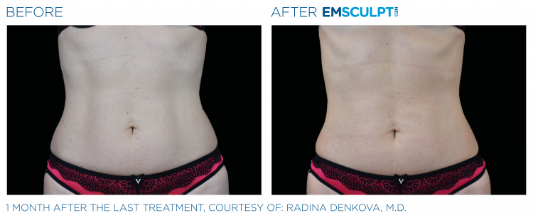 Before and after | EMSCULPT NEO | Body Sculpting