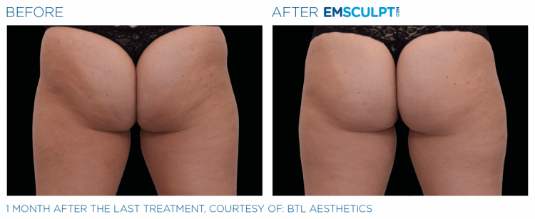 Before and after | EMSCULPT NEO | Body Sculpting