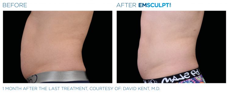 Before and after | EMSCULPT NEO | Body Sculpting