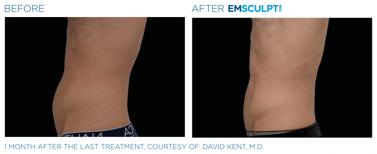 Before and after | EMSCULPT NEO | Body Sculpting