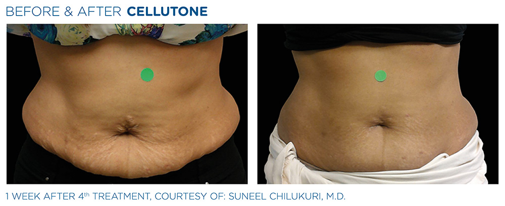 Before and after | CELLUTONE | Cellulite Treatments